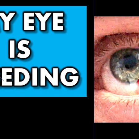 Your eye is bleeding: What is it and how to treat a subconjunctival ...