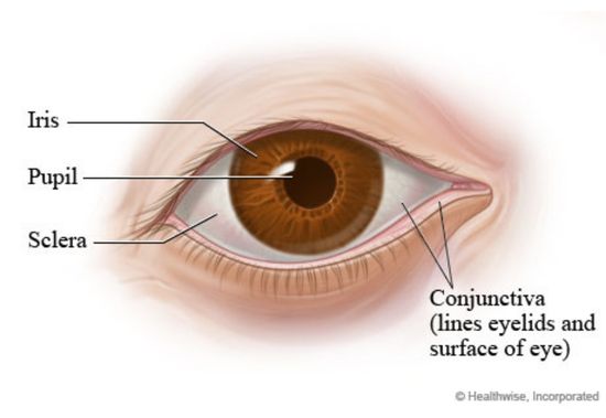 Diagram explaining where a burst blood vessel occurs on the eye.