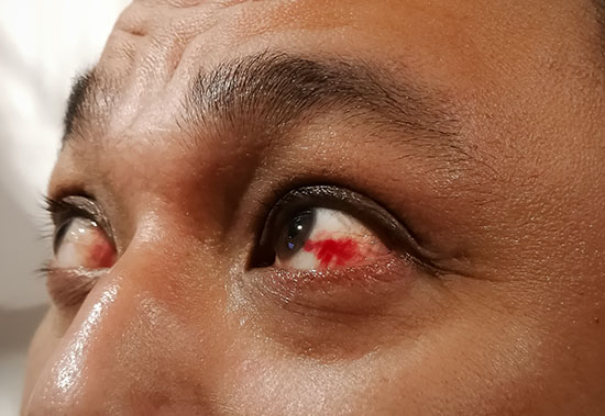 Popped blood vessel on the white of the eye showing a red patch.